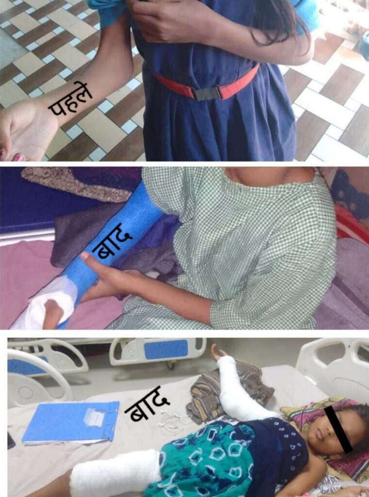 सारंगढ़-बिलाईगढ़ : चिरायु से 10 वर्षीय सीमा के जन्मजात विकृति का हुआ निःशुल्क ऑपरेशन…