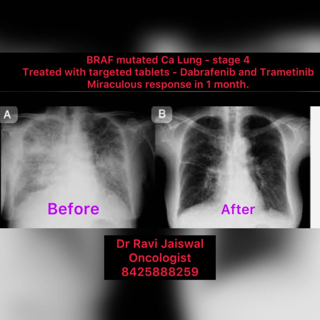 डॉ.रवि जायसवाल की एक और बड़ी उपलब्धि, नो कीमो-नो सर्जरी, केवल टेबलेट से दुर्लभ किस्म के चौथे स्टेज के लग्स कैंसर का सफल इलाज…