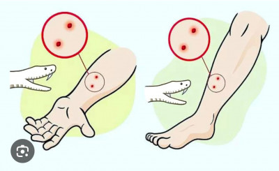 रायपुर : सांप डसे तो झाड़-फूंक में समय न गवाएं, तुरंत अस्पताल पहुंचे