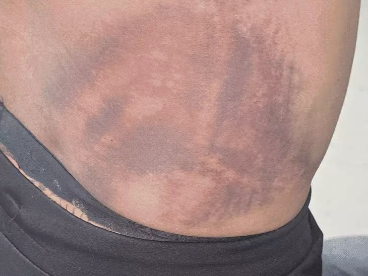 हेड-कॉन्स्टेबल ने हाईवा ड्राइवर और कंडक्टर की बेसबाल और हाथ-मुक्का-लात से बेरहमी से की पिटाई…पुलिस बोली-रेस ड्राइविंग कर रहा था हाईवा चालक…