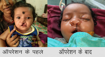 रायपुर : चिरायु योजना ने लौटाई मासूमों की मुस्कान