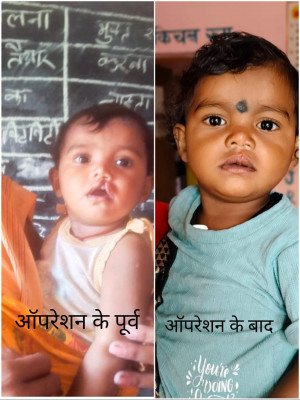 रायपुर : शासन की योजना से दूर हुई बेटी के भविष्य की चिंता, चिरायु दल ने लौटाई मासूम रंजना की मुस्कान